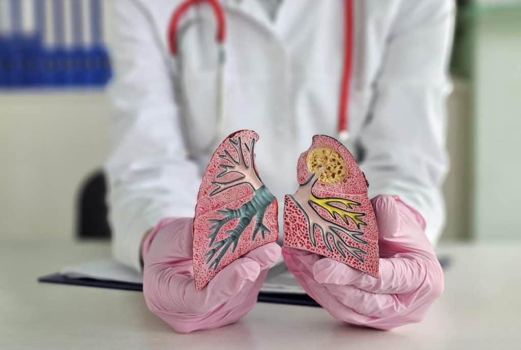 j'ai guéri d'un cancer du poumon métastasé