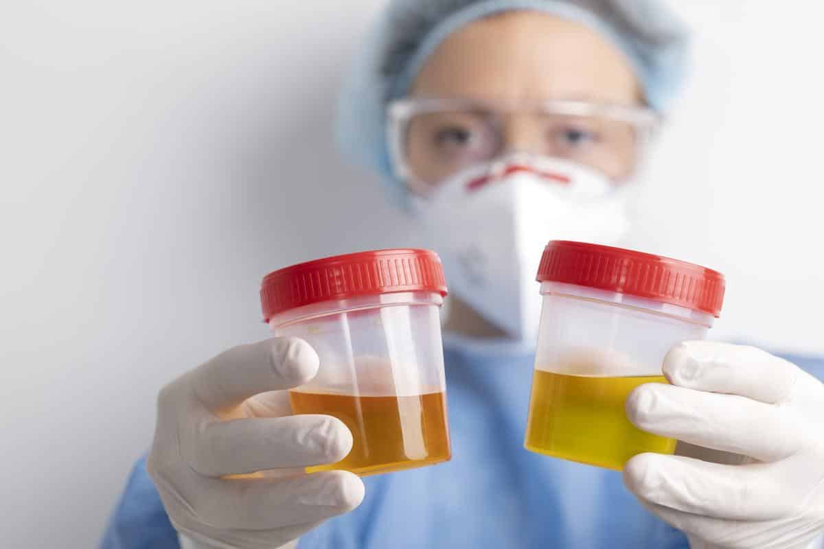 couleur urine diabetique​